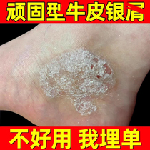 脚癣药膏真菌感染脚藓脚裂皮肤病脚干裂脱皮脚后跟真菌银屑病药膏