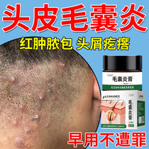 头皮溢脂性毛囊炎真菌感染头皮屑痒头癣专用马拉色菌头皮癣膏NK
