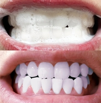 洗牙神器~牙渍一擦即除~黑色烟渍~茶渍~去牙菌斑咖啡渍牙齿变白