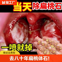 扁桃体结石去除工具漱口水喷剂口腔口臭咽喉清理隐窝冲洗器牙神器
