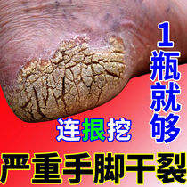 脚后跟开裂药膏克星手脚真菌感染脱皮手上起皮干裂皲裂手指修复霜